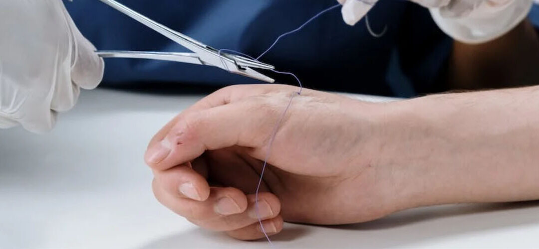 Suturing (Stitches)